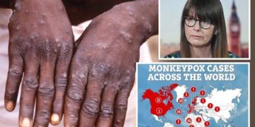 SA unlikely to impose harsh lockdown over monkeypox outbreak